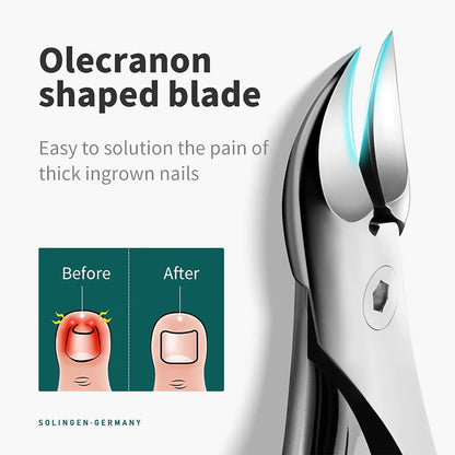 MR.GREEN olecranon-shaped blade infographic with before and after result for ingrown toenails; reaches nail groove to ease pain