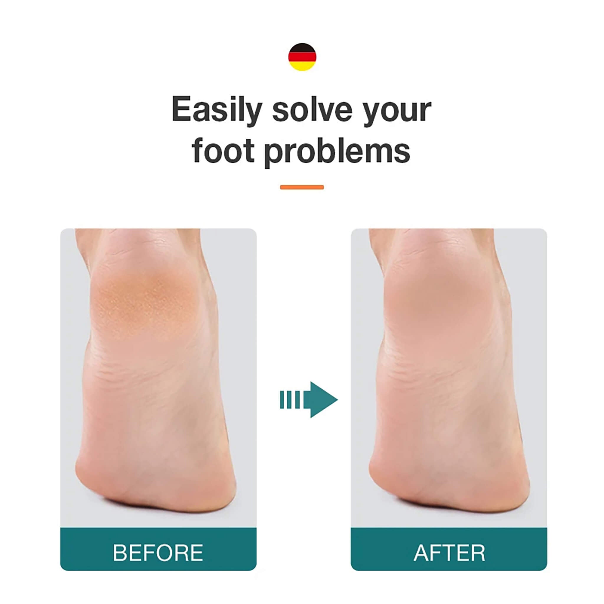 Antes y después: talones suaves tras usar la lima de pies MR.GREEN MR-2208 doble cara de acero inoxidable; elimina callos y piel muerta.