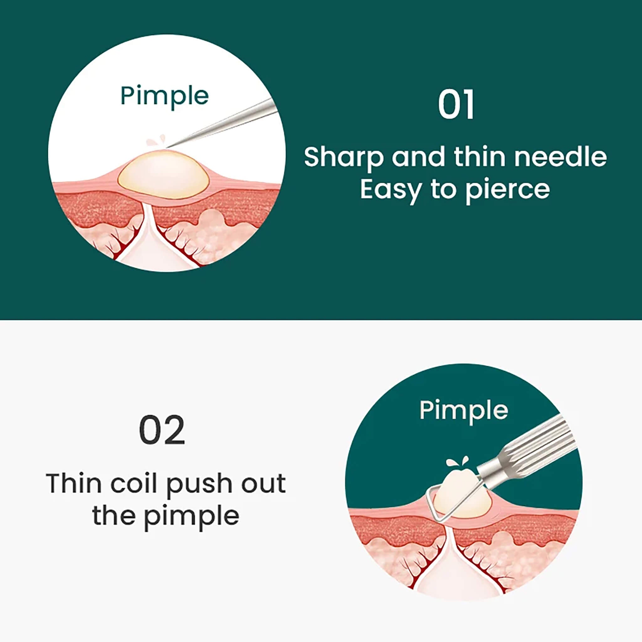 MR.GREEN doppelseitige Aknenadel: Schritt 1 Nadel punktiert, Schritt 2 Schlinge drückt Pickel hygienisch heraus.